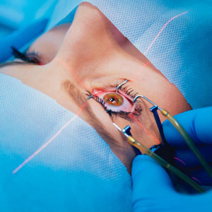 Bladeless LASIK Bladeless LASIK