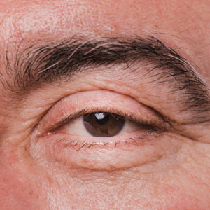 Blepharitis Blepharitis