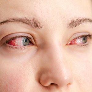 Conjunctivitis (Pink Eye) Conjunctivitis (Pink Eye)