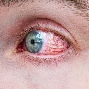 Corneal Ulcer (Keratitis) Corneal Ulcer (Keratitis)