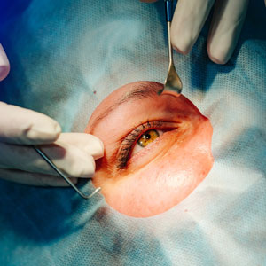 PRK Surgery PRK Surgery