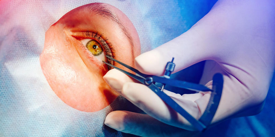 PRK Surgery