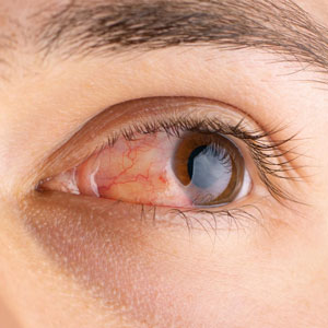 Pterygium (Surfer’s Eye) Pterygium (Surfer’s Eye)