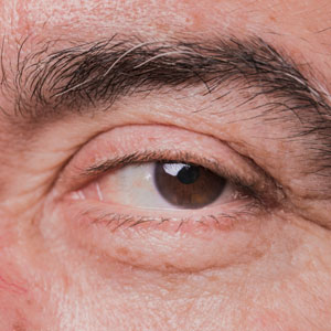 Ptosis (Droopy Eyelid) Ptosis (Droopy Eyelid)