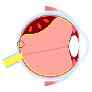 Retinal Detachment Retinal Detachment
