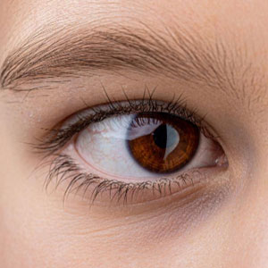 Squint (Strabismus) Squint (Strabismus)