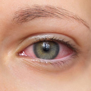 Uveitis Uveitis