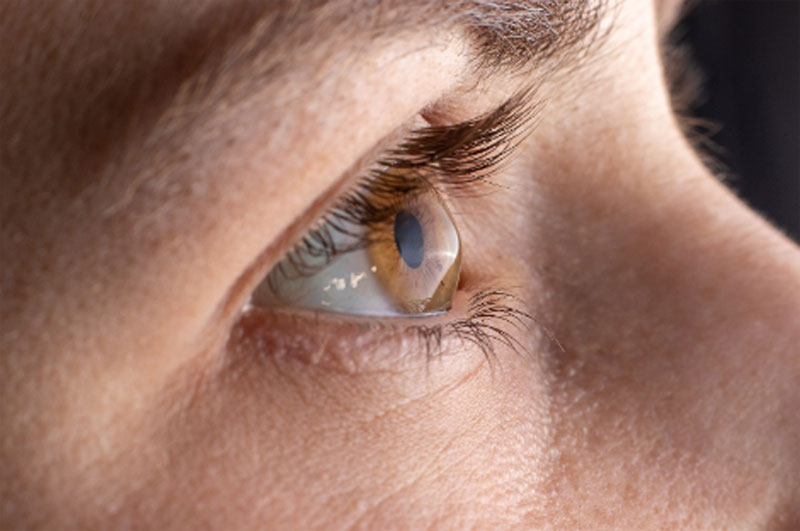 What Is Keratoconus Treatment What Is Keratoconus Treatment
